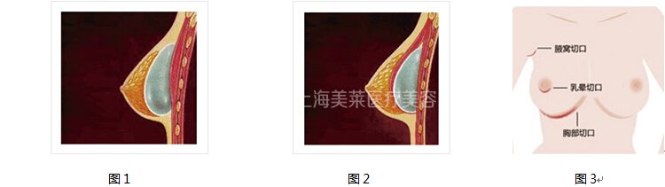 假体丰胸